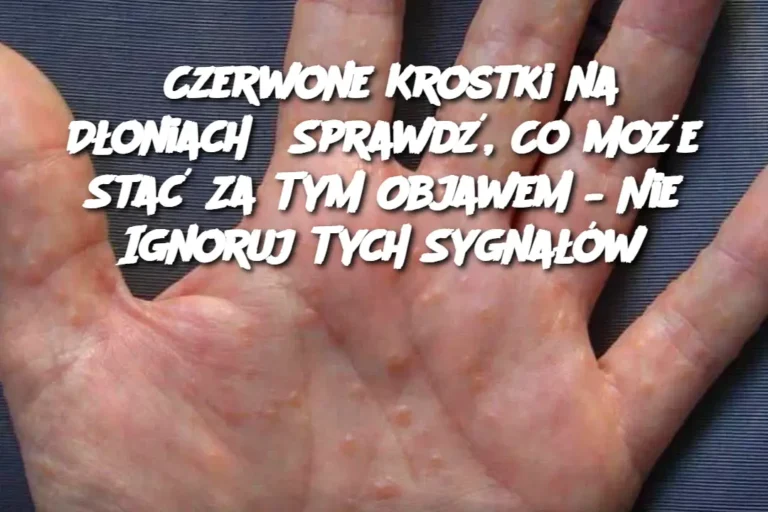 Czerwone_Krostki_na_D_oniach__Sprawd___Co_Mo_e_Sta__Za_Tym_Objawem___Nie_Ignoruj_Tych_Sygna__w