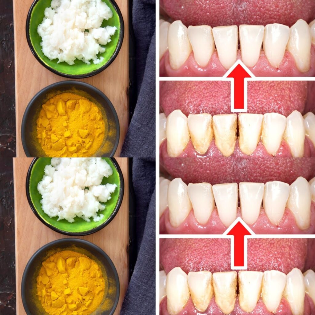 Jak_usun___kamie__i_osad_naz_bny_bez_dentysty__kurkuma_i_s_l-1 Jak_usun___kamie__i_osad_naz_bny_bez_dentysty__kurkuma_i_s_l-1