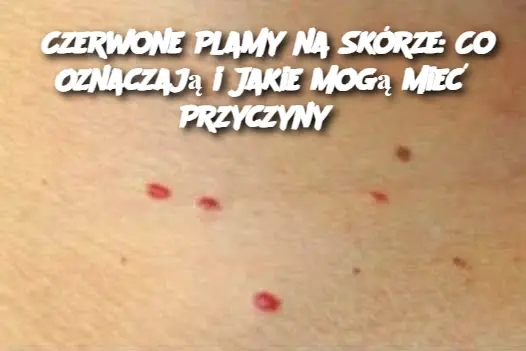 Czerwone_Plamy_na_Sk_rze__Co_Oznaczaj__i_Jakie_Mog__Mie__Przyczyny_ Czerwone_Plamy_na_Sk_rze__Co_Oznaczaj__i_Jakie_Mog__Mie__Przyczyny_