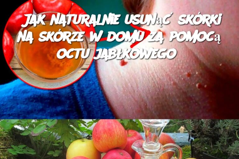 Jak_naturalnie_usun___sk_rki_na_sk_rze_w_domu_za_pomoc__octu_jab_kowego