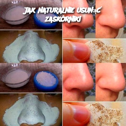 Jak_naturalnie_usun___zask_rniki Jak_naturalnie_usun___zask_rniki