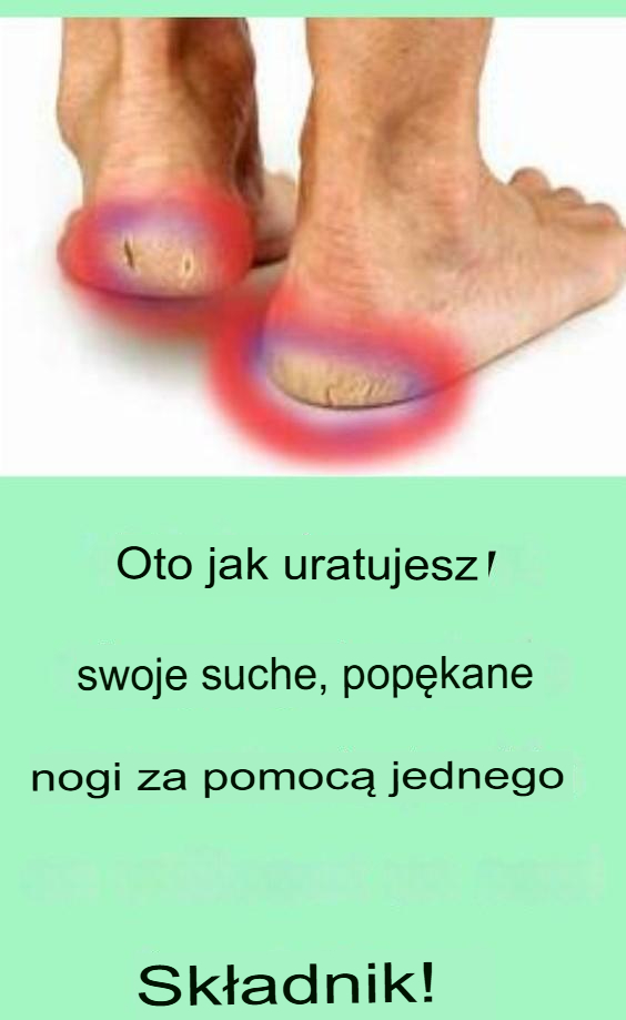 Jak_uratowa__suche__pop_kane_stopy_za_pomoc__tylko_jednego_sk_adnika_ Jak_uratowa__suche__pop_kane_stopy_za_pomoc__tylko_jednego_sk_adnika_