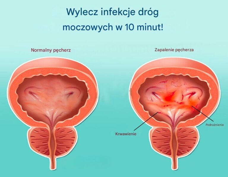 Jak_wyleczy__infekcje_dr_g_moczowych_w_10_minut_