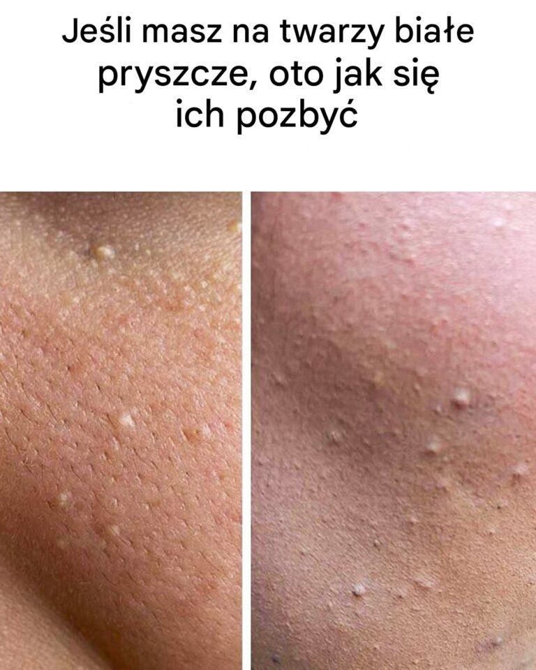 Je_li_masz_bia_e_pryszcze_na_twarzy__oto_co_one_oznaczaj__i_jak_si__ich_pozby_