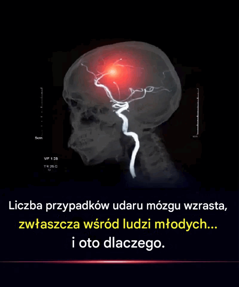 Przypadki_udaru_m_zgu_s__coraz_cz_stsze__zw_aszcza_w_r_d_ludzi_m_odych__i_oto_dlaczego_