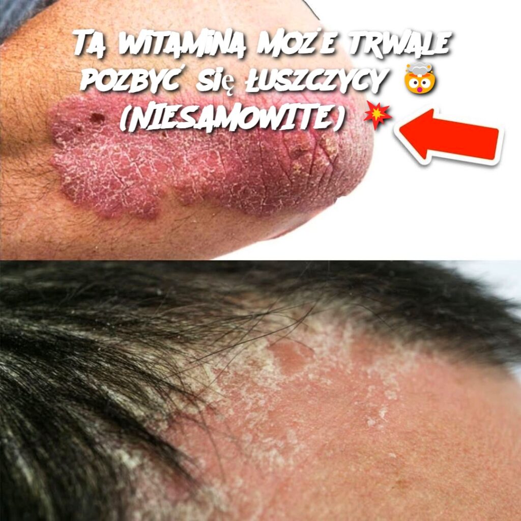 Ta_witamina_mo_e_trwale_pozby__si___uszczycy_____NIESAMOWITE____ Ta_witamina_mo_e_trwale_pozby__si___uszczycy_____NIESAMOWITE____