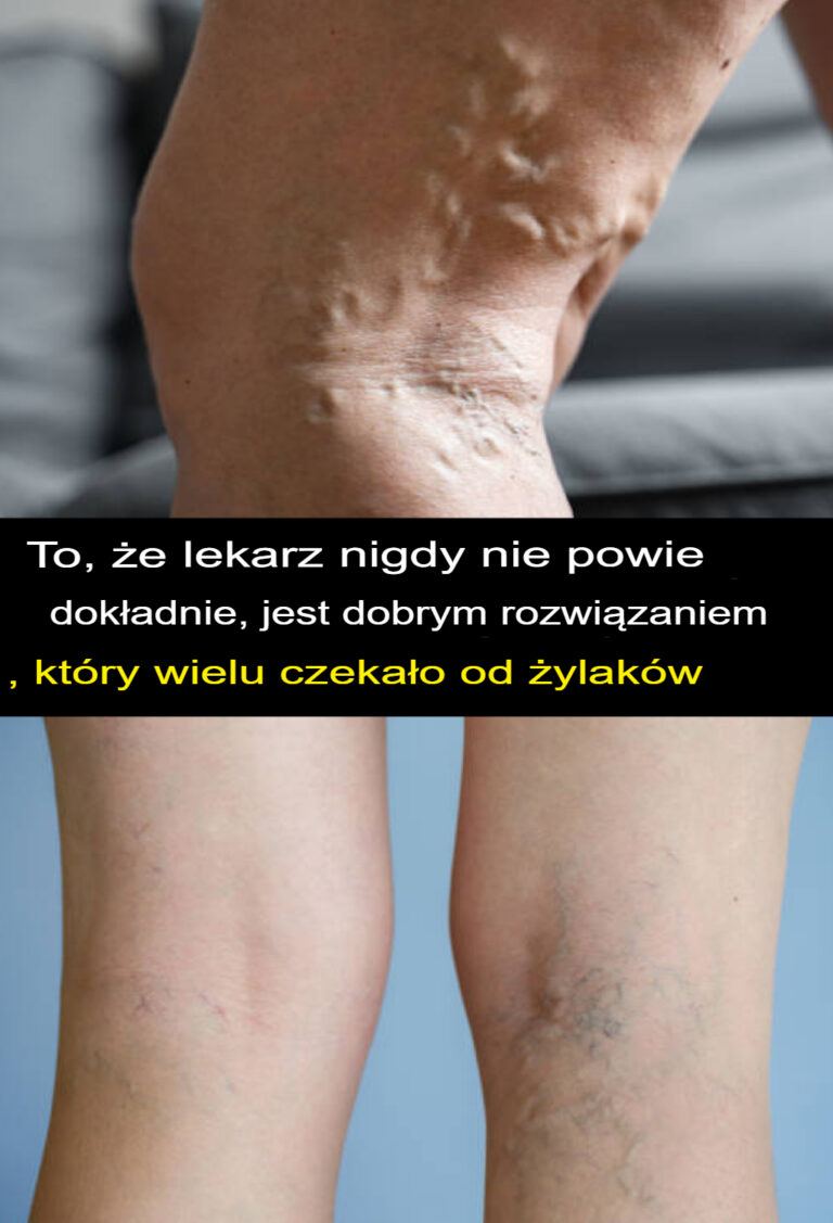 To__czego_nigdy_nie_powie_Ci_lekarz__okazuje_si__by__rozwi_zaniem__na_kt_re_czeka_o_wiele_os_b_w_walce_z__ylakami