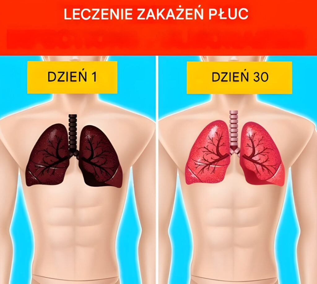 10_naturalnych_sposob_w_leczenia_infekcji_p_uc__domowe_sposoby_-1 10_naturalnych_sposob_w_leczenia_infekcji_p_uc__domowe_sposoby_-1