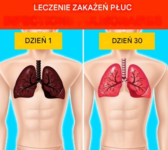10_naturalnych_sposob_w_leczenia_infekcji_p_uc__domowe_sposoby_ 10_naturalnych_sposob_w_leczenia_infekcji_p_uc__domowe_sposoby_