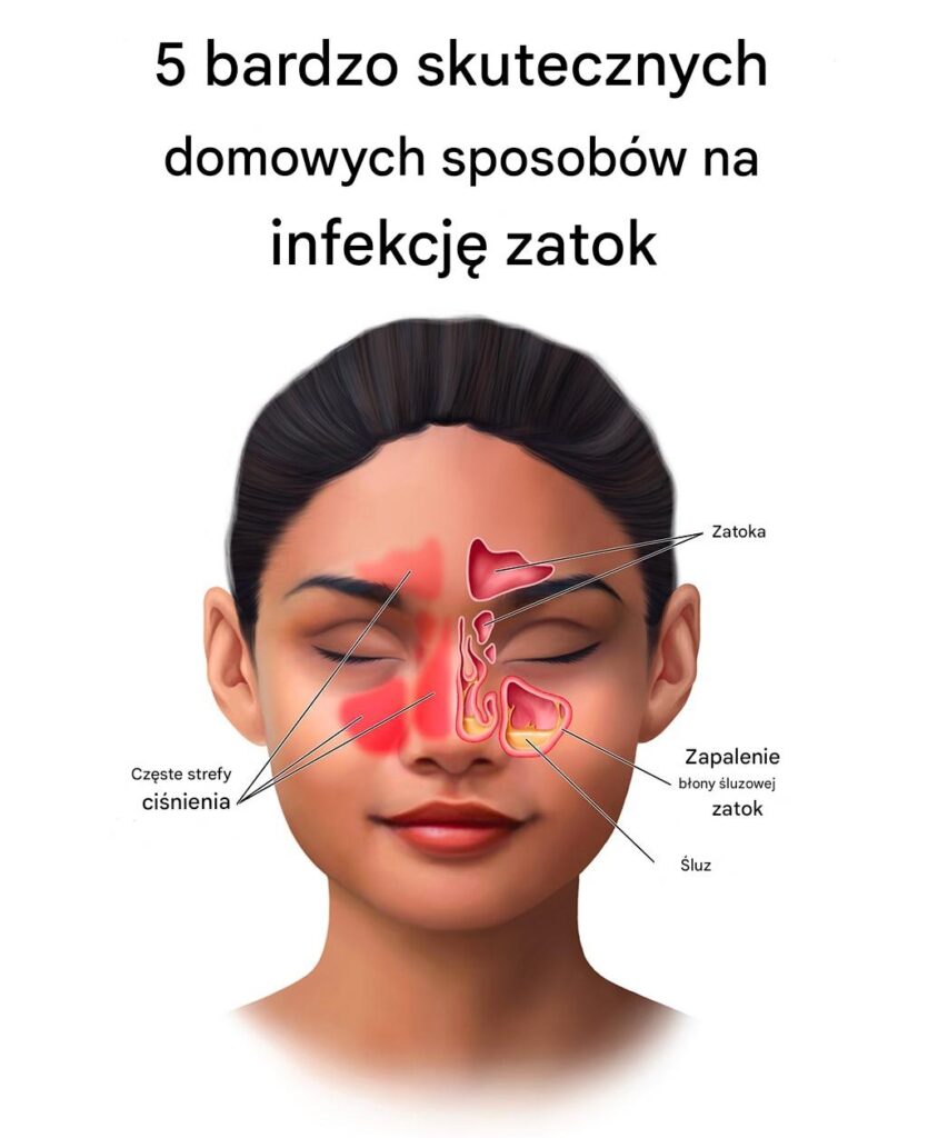 5_bardzo_skutecznych_domowych_sposob_w_na_infekcj__zatok 5_bardzo_skutecznych_domowych_sposob_w_na_infekcj__zatok