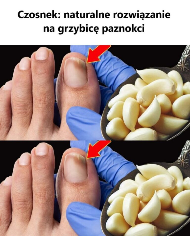 Czosnek__naturalne_rozwi_zanie_na_grzybic__paznokci