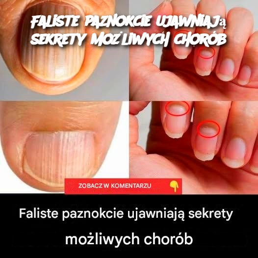 Faliste_paznokcie_ujawniaj__sekrety_mo_liwych_chor_b Faliste_paznokcie_ujawniaj__sekrety_mo_liwych_chor_b