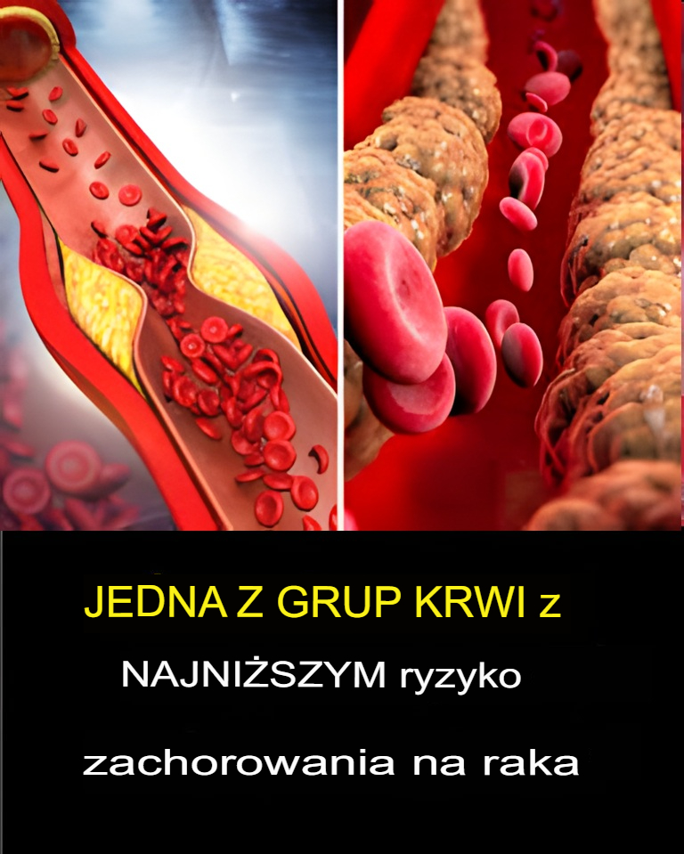 Lekarze_ujawniaj__grup__krwi_o_najni_szym_ryzyku_zachorowania_na_raka Lekarze_ujawniaj__grup__krwi_o_najni_szym_ryzyku_zachorowania_na_raka