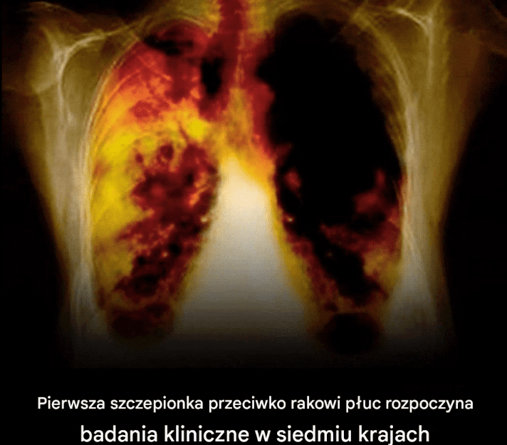 Prze_om_w_onkologii__Pierwsza_szczepionka_na_raka_p_uc_wchodzi_w_faz__bada__klinicznych_w_siedmiu_krajach Prze_om_w_onkologii__Pierwsza_szczepionka_na_raka_p_uc_wchodzi_w_faz__bada__klinicznych_w_siedmiu_krajach
