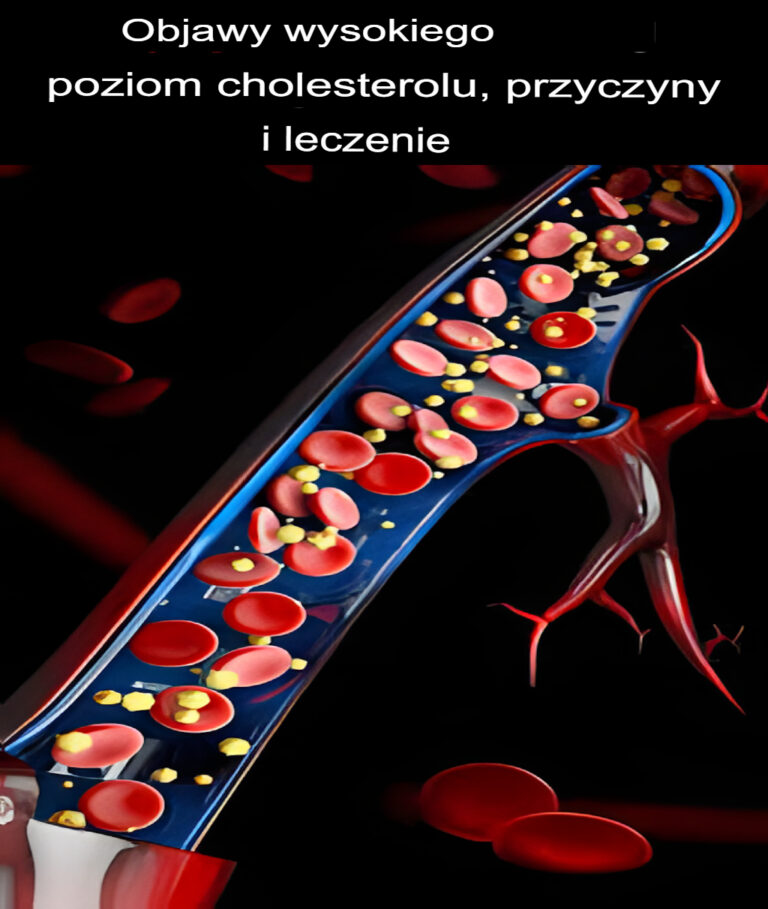 Wysoki_poziom_cholesterolu___objawy__przyczyny_i_leczenie