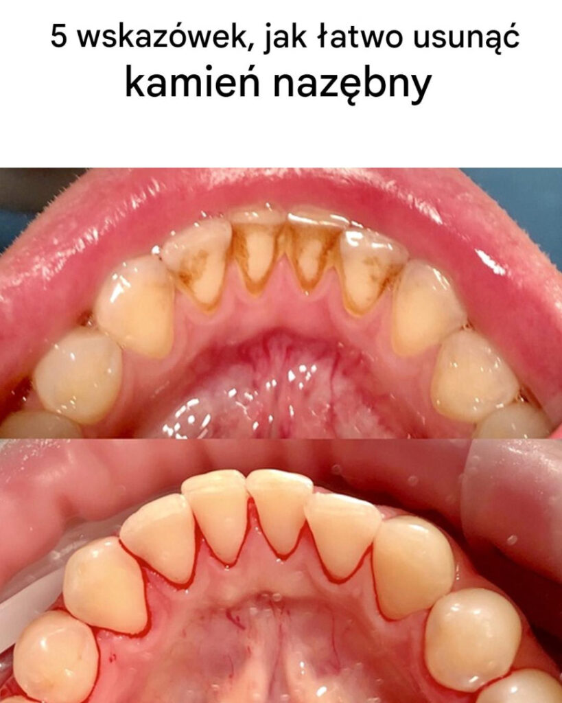10_wskaz_wek__jak_usun___kamie__naz_bny 10_wskaz_wek__jak_usun___kamie__naz_bny