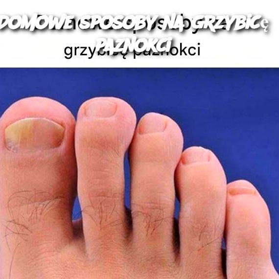 Domowe_sposoby_na_grzybic__paznokci Domowe_sposoby_na_grzybic__paznokci