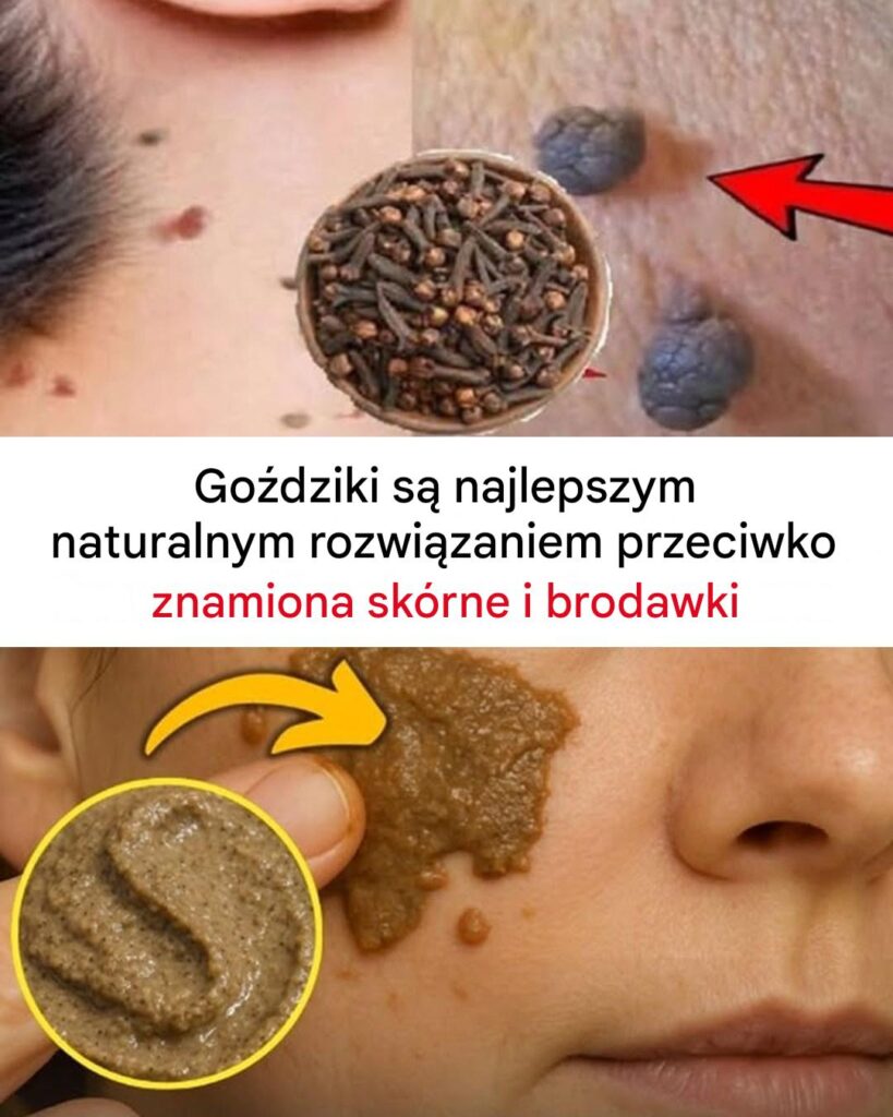 Go_dziki_usuwaj__naro_la_sk_rne_i_brodawki__Jak_je_stosowa__ Go_dziki_usuwaj__naro_la_sk_rne_i_brodawki__Jak_je_stosowa__