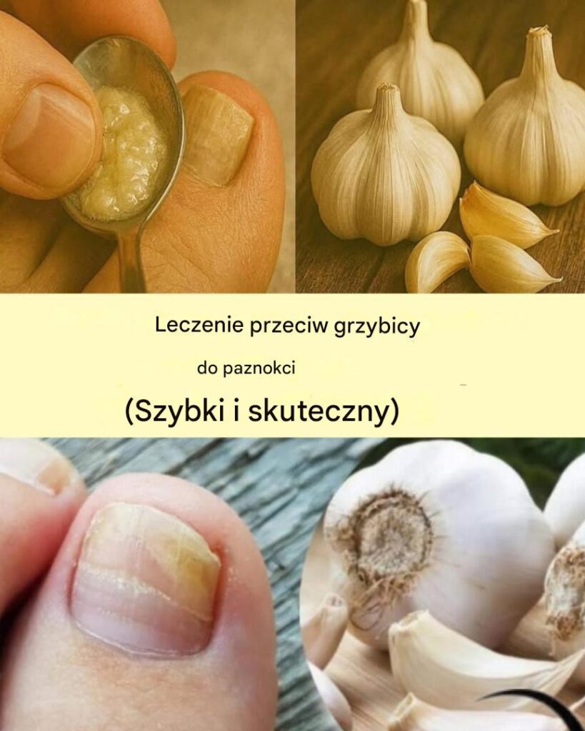 Jak_mo_na_wykorzysta__czosnek_do_walki_z_grzybic__paznokci-1 Jak_mo_na_wykorzysta__czosnek_do_walki_z_grzybic__paznokci-1