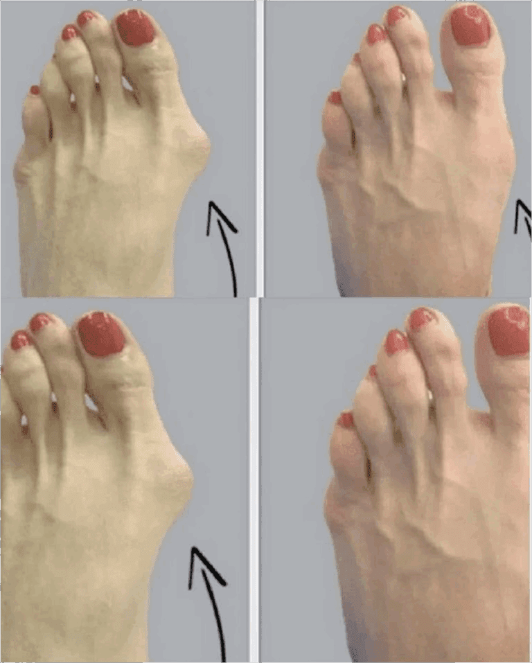 Jak_naturalnie_z_agodzi__haluksy__hallux_valgus__