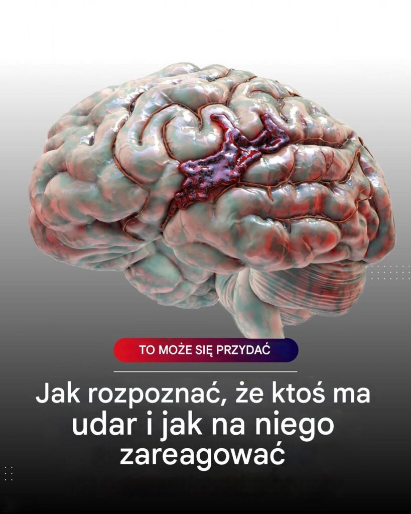 Jak_rozpozna__udar_m_zgu___CVA_ Jak_rozpozna__udar_m_zgu___CVA_