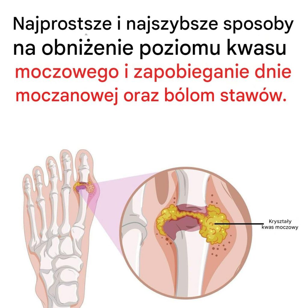 Jak_z_agodzi__b_l_staw_w_spowodowany_dn__moczanow__ Jak_z_agodzi__b_l_staw_w_spowodowany_dn__moczanow__