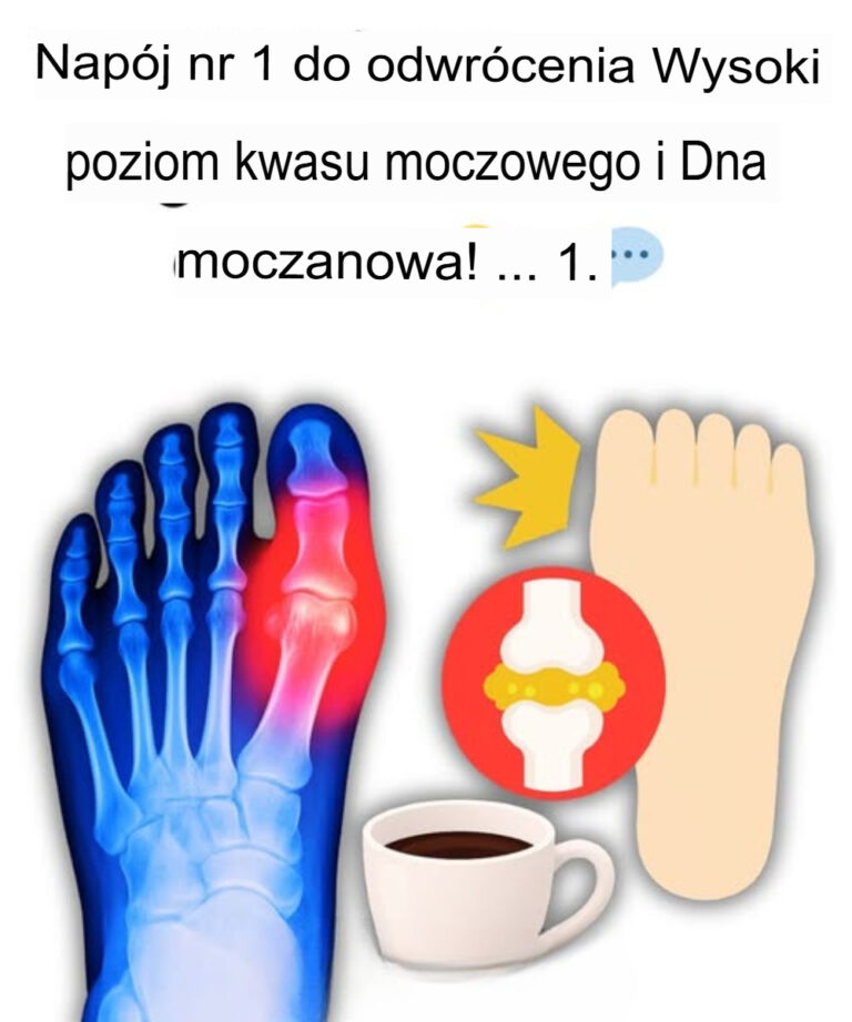 Nap_j_nr_1_na_odwr_cenie_objaw_w_wysokiego_poziomu_kwasu_moczowego_i_dny_moczanowej_