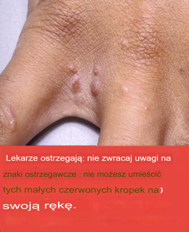 Nie_ignoruj_tych_ma_ych_czerwonych_plamek_na_ramieniu__mog__to_by__powa_ne_sygna_y_ostrzegawcze_