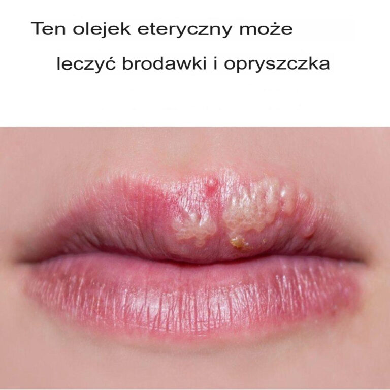 Olejek_z_drzewa_herbacianego_na_brodawki_i_opryszczk_