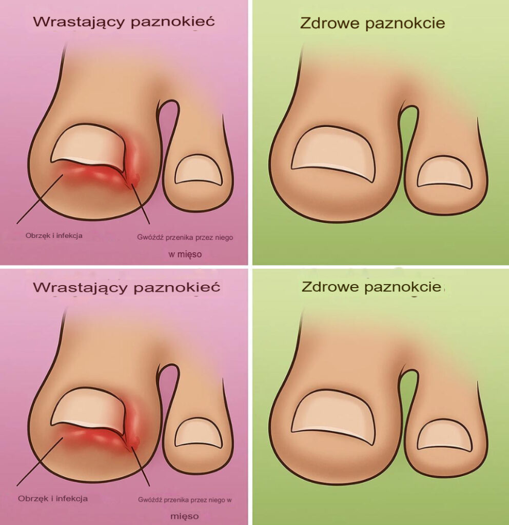 Wrastaj_ce_paznokcie_u_st_p__Jak_szybko_i_naturalnie_sobie_z_nimi_poradzi__w_domu Wrastaj_ce_paznokcie_u_st_p__Jak_szybko_i_naturalnie_sobie_z_nimi_poradzi__w_domu