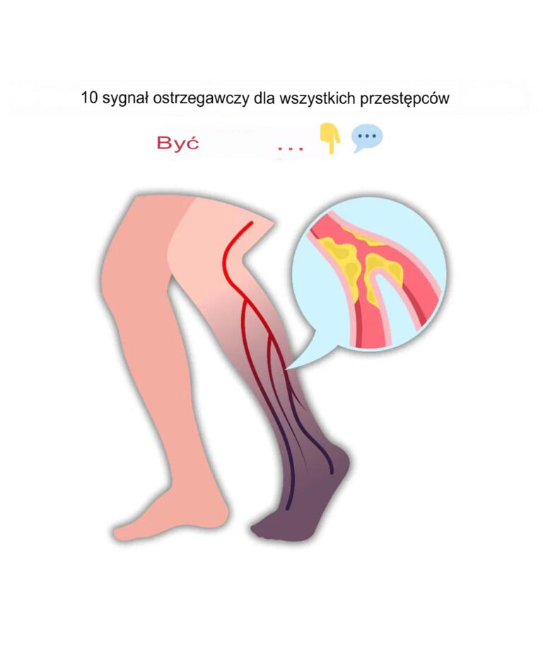 10_najcz_stszych_objaw_w_zakrzepu_krwi_w_nodze__zapobiegaj_cych_zakrzepicy__y__g__bokich_