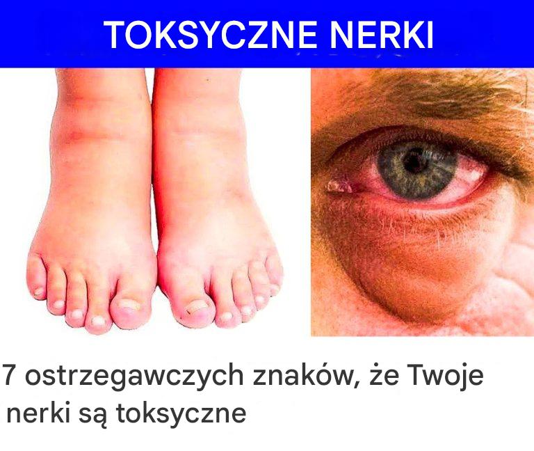 7_ostrzegawczych_znak_w___e_Twoje_nerki_s__toksyczne 7_ostrzegawczych_znak_w___e_Twoje_nerki_s__toksyczne