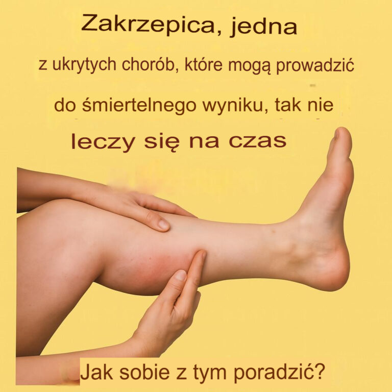 Czym_jest_zakrzepica_i_jakie_s__jej_objawy_