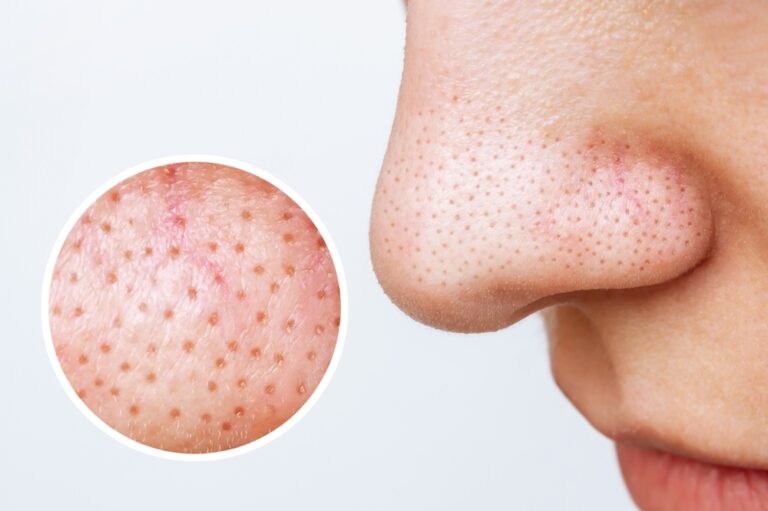 Female,Nose,With,Blackheads,Or,Black,Dots,And,Magnifying,Glass