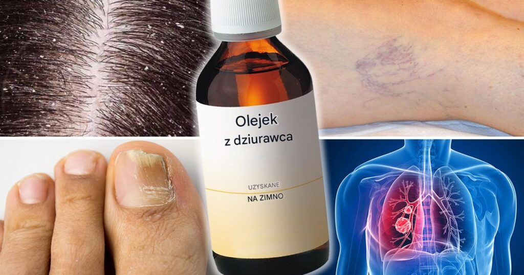 Do_czego_s_u_y_olejek_z_dziurawca_i_jak_go_stosowa___Jest_to_jeden_z_najskuteczniejszych_olejk_w_przeciwzapalnych_i_antybakteryjnych_ Do_czego_s_u_y_olejek_z_dziurawca_i_jak_go_stosowa___Jest_to_jeden_z_najskuteczniejszych_olejk_w_przeciwzapalnych_i_antybakteryjnych_