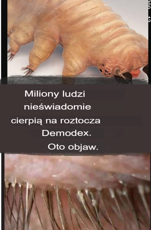 Jak_zidentyfikowa__roztocza_Demodex Jak_zidentyfikowa__roztocza_Demodex