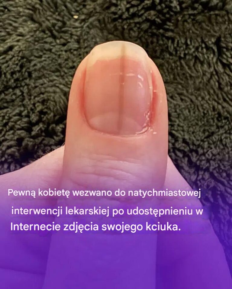 Pewn__kobiet__wezwano_do_natychmiastowej_interwencji_lekarskiej_po_udost_pnieniu_w_Internecie_zdj_cia_swojego_kciuka_