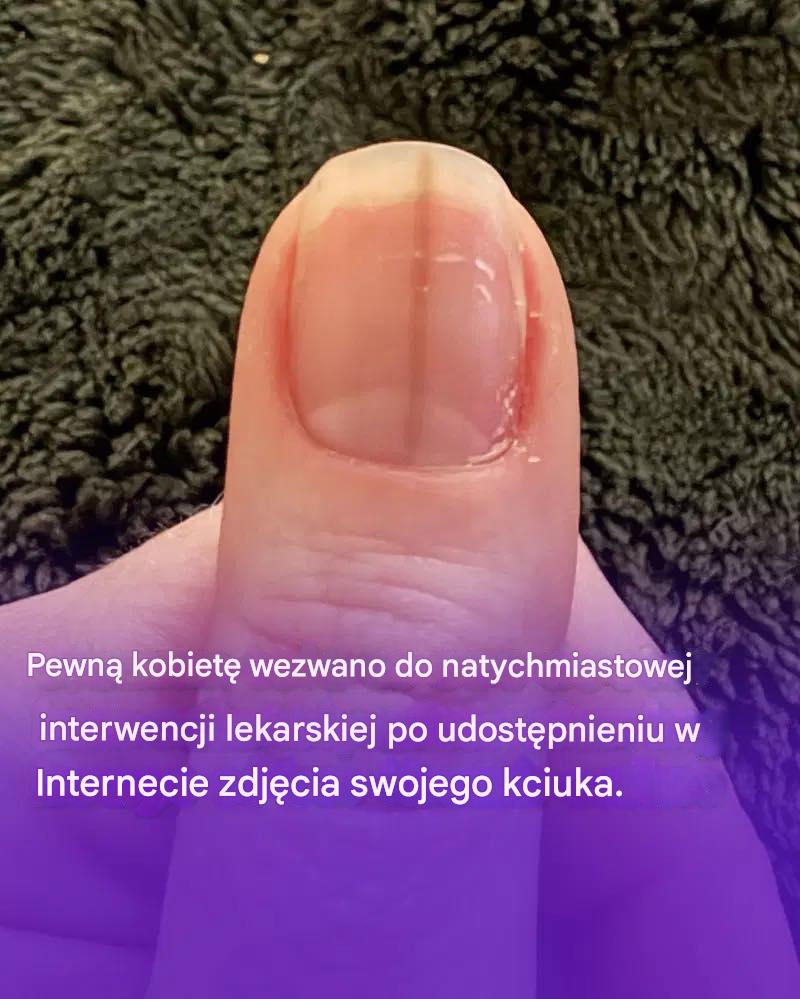 Pewn__kobiet__wezwano_do_natychmiastowej_interwencji_lekarskiej_po_udost_pnieniu_w_Internecie_zdj_cia_swojego_kciuka_ Pewn__kobiet__wezwano_do_natychmiastowej_interwencji_lekarskiej_po_udost_pnieniu_w_Internecie_zdj_cia_swojego_kciuka_