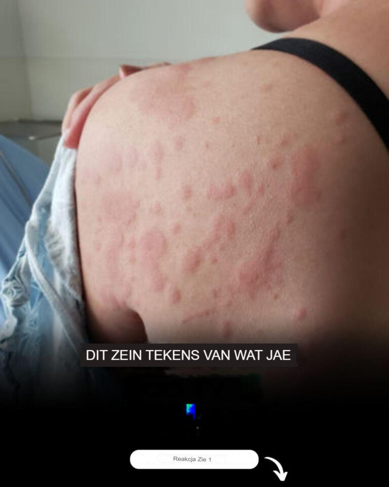 Pokrzywka__Alergia__Ca_e_cia_o_j__sw_dzia_o__a_lekarze_postawili_najgorsz__diagnoz__