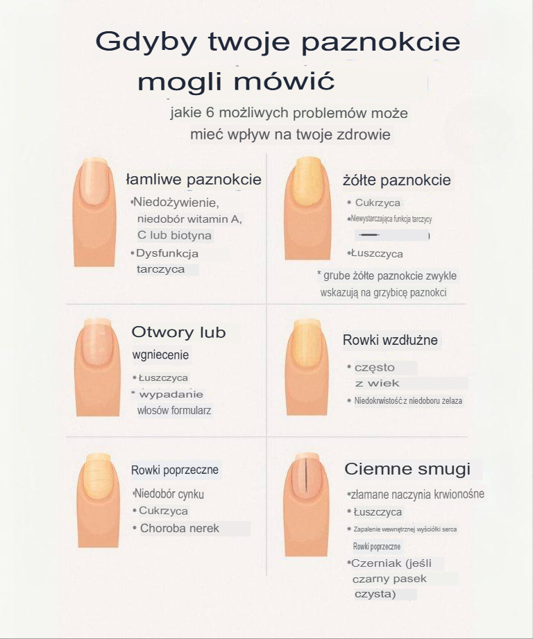 Twoje_paznokcie_zdradzaj__stan_Twojego_zdrowia___6_ostrzegawczych_sygna__w__kt_re_powinna__zna___ Twoje_paznokcie_zdradzaj__stan_Twojego_zdrowia___6_ostrzegawczych_sygna__w__kt_re_powinna__zna___