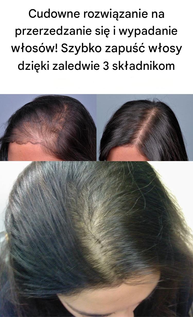 Zabieg_zag_szczania_w_os_w