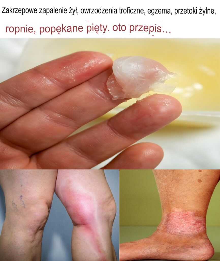 Zakrzepowe_zapalenie__y___owrzodzenia_troficzne__egzema__przetoki__ylne__ropnie__pop_kane_pi_ty__Oto_przepis_ Zakrzepowe_zapalenie__y___owrzodzenia_troficzne__egzema__przetoki__ylne__ropnie__pop_kane_pi_ty__Oto_przepis_