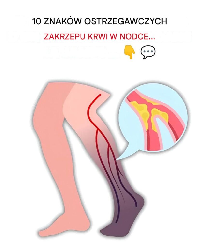 10_najcz_stszych_objaw_w_zakrzepu_krwi_w_nodze__zapobieganie_zakrzepicy__y__g__bokich_-1 10_najcz_stszych_objaw_w_zakrzepu_krwi_w_nodze__zapobieganie_zakrzepicy__y__g__bokich_-1
