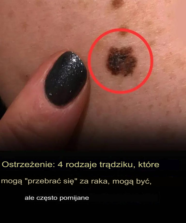 4_rodzaje_pryszczy__kt_re_mog__by___kamufla_em__raka 4_rodzaje_pryszczy__kt_re_mog__by___kamufla_em__raka