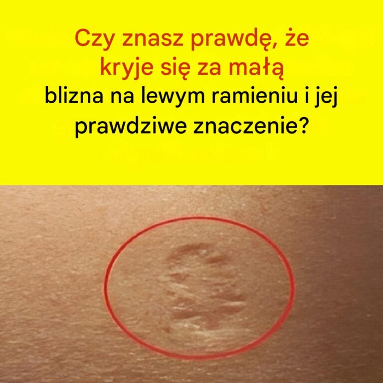 Blizny_po_szczepionce_przeciwko_ospie__Jak_wygl_daj__i_dlaczego_si__pojawiaj__