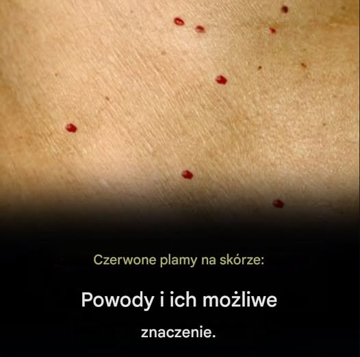Czerwone_plamy_na_sk_rze__11_przyczyn_ Czerwone_plamy_na_sk_rze__11_przyczyn_