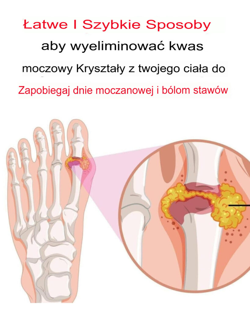 Jak_naturalnie_odwr_ci__dn__moczanow__i_z_agodzi__b_l_staw_w Jak_naturalnie_odwr_ci__dn__moczanow__i_z_agodzi__b_l_staw_w