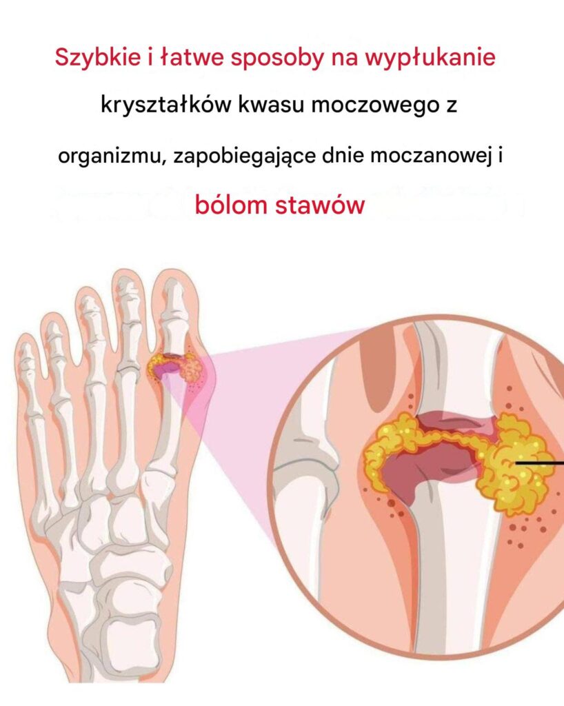 Jak_naturalnie_odwr_ci__objawy_dny_moczanowej_i_z_agodzi__b_l_staw_w-1 Jak_naturalnie_odwr_ci__objawy_dny_moczanowej_i_z_agodzi__b_l_staw_w-1