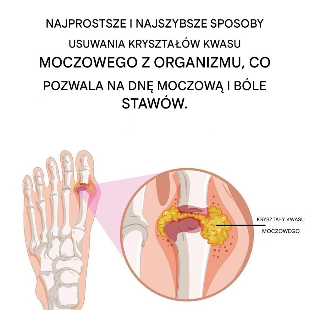 Jak_naturalnie_z_agodzi__dn__moczanow__i_b_l_staw_w Jak_naturalnie_z_agodzi__dn__moczanow__i_b_l_staw_w