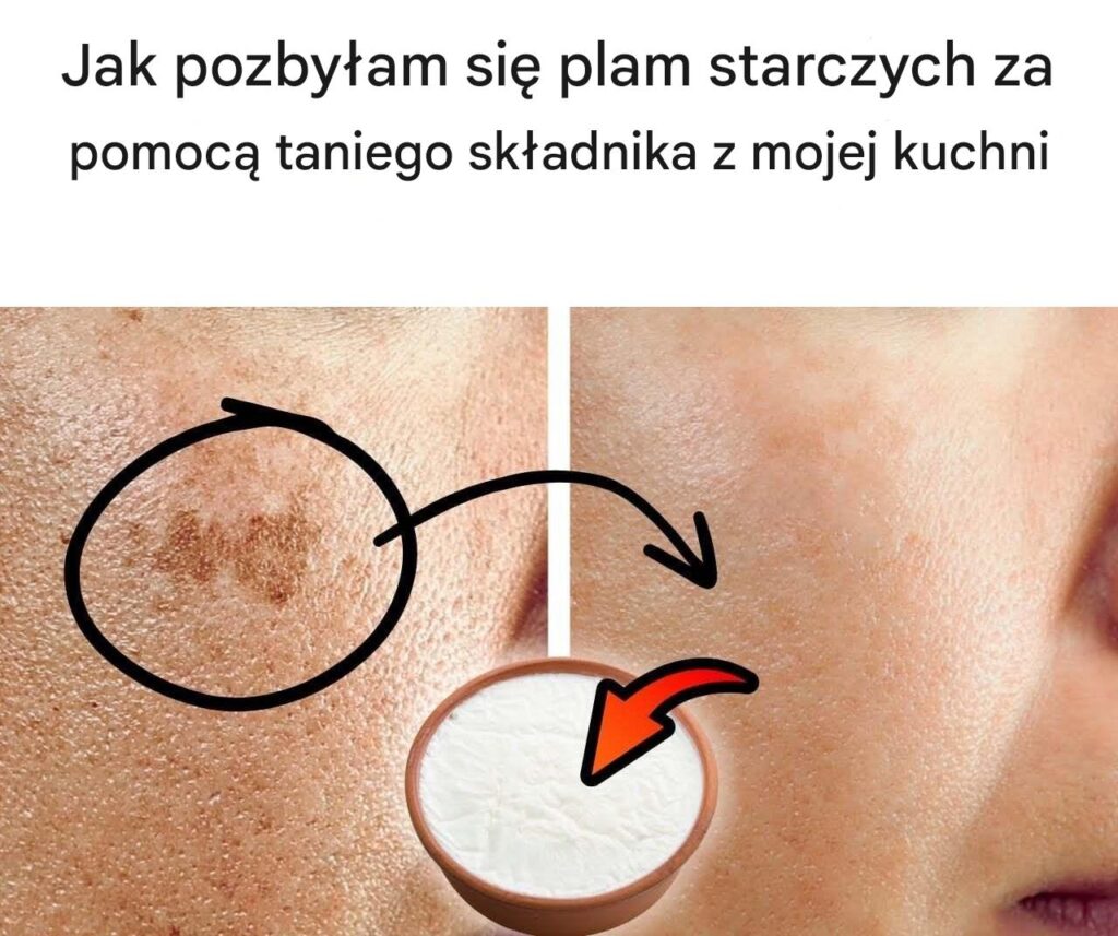 Jak_pozby_am_si__plam_starczych_za_pomoc__taniego_sk_adnika_z_mojej_kuchni-1 Jak_pozby_am_si__plam_starczych_za_pomoc__taniego_sk_adnika_z_mojej_kuchni-1